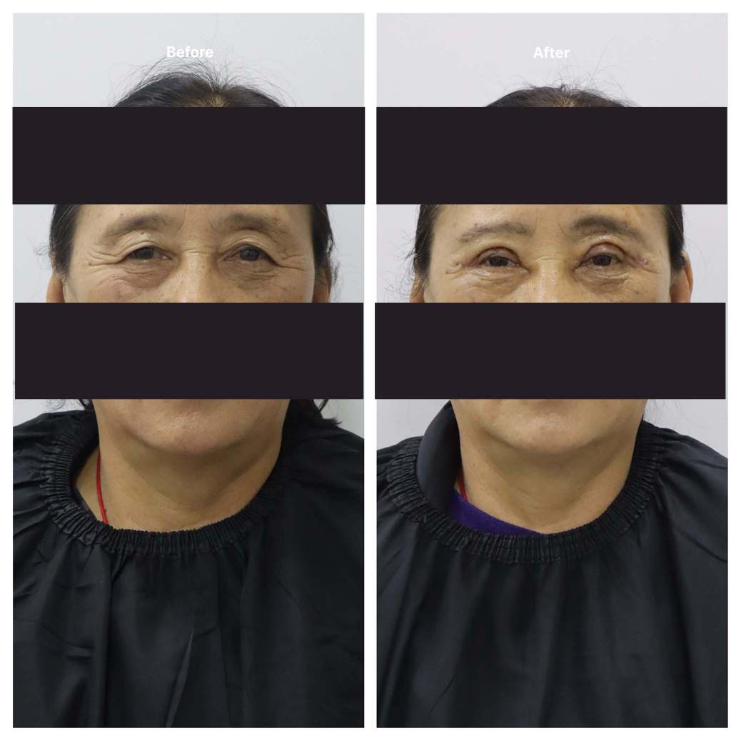 Eyelid Surgery KOQ10